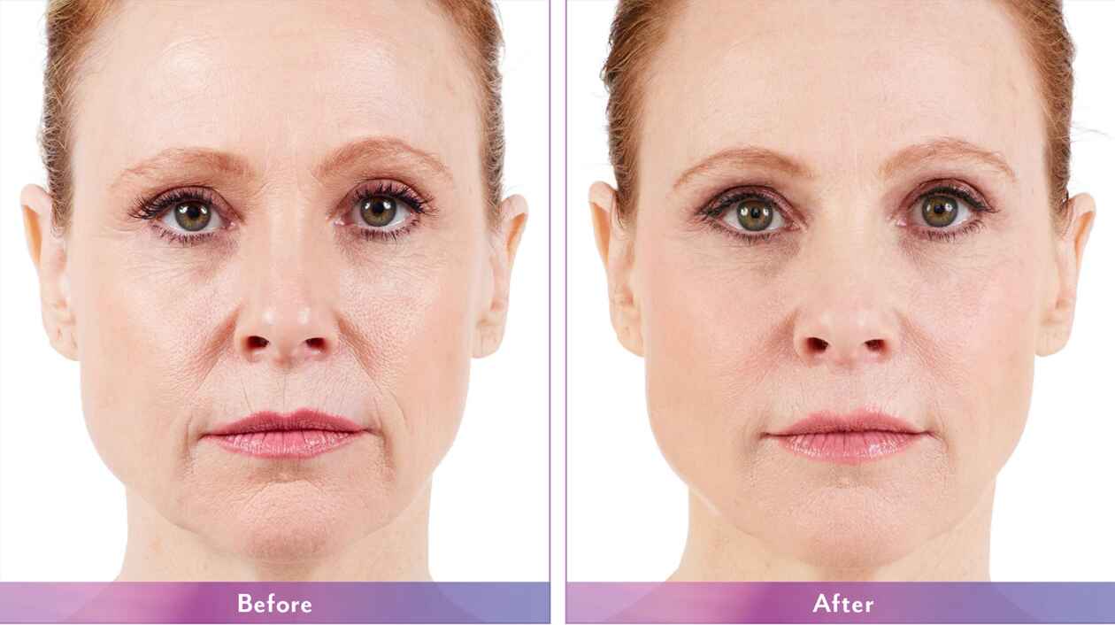 Juvederm1