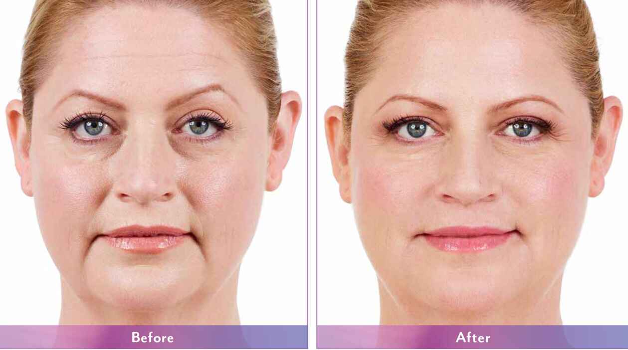 Juvederm2