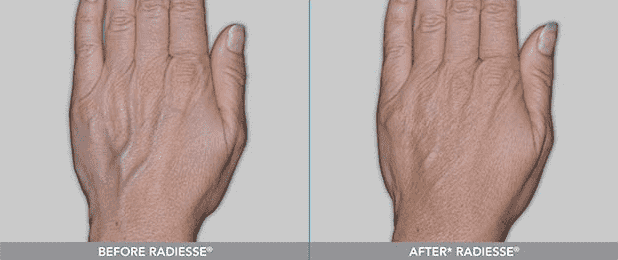 hand-rejuvenation